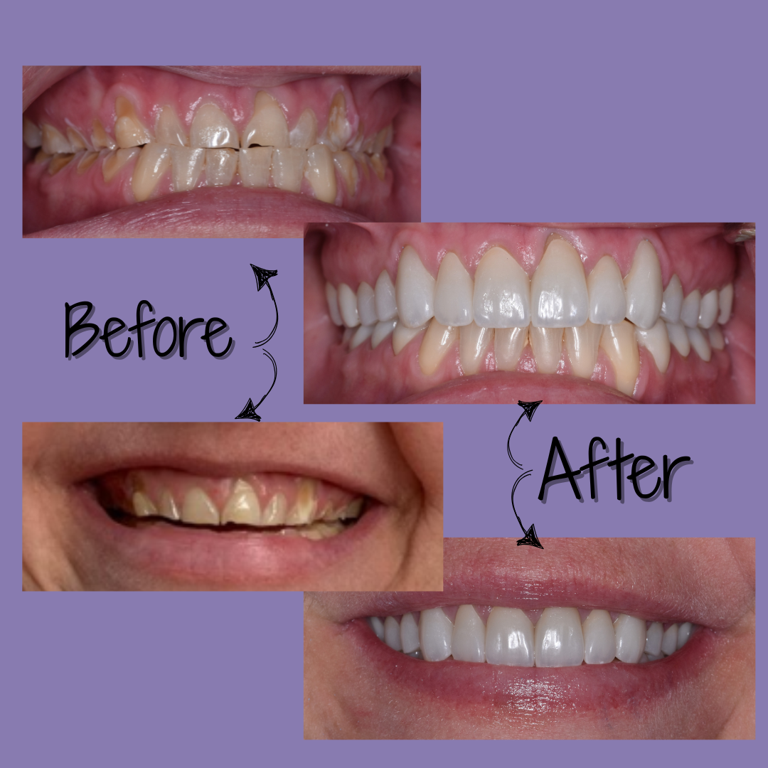 Dental restoration in Phoenix