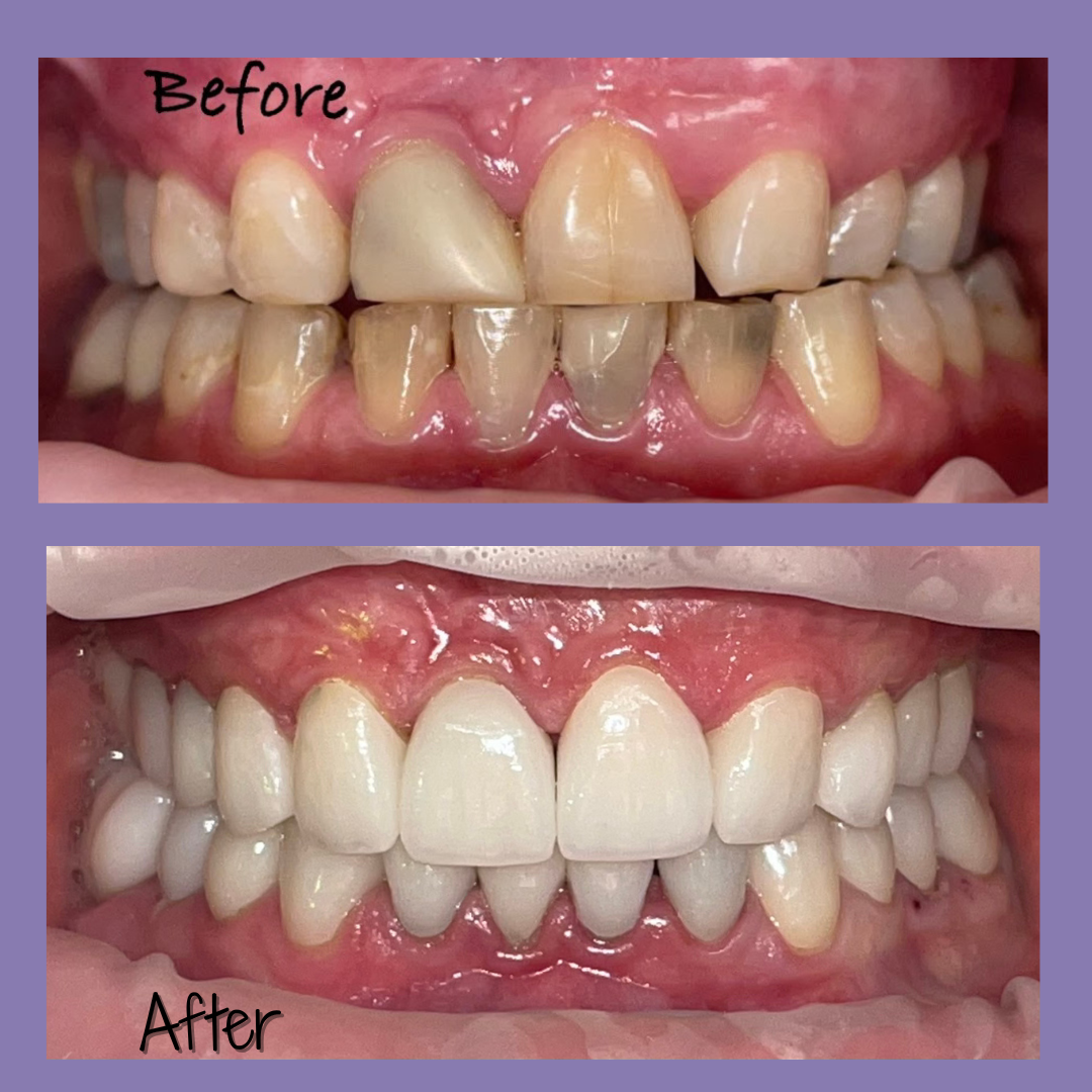 Cosmetic Dentistry before after