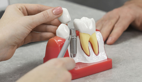 Dental Implants in Price, UT