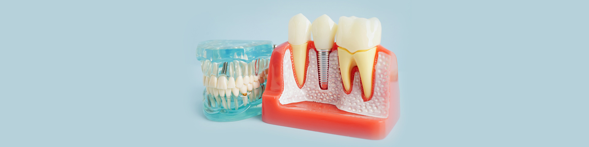 Dental Implants