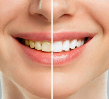 Teeth Whitening
