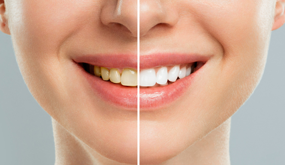 Teeth Whitening in Price, UT